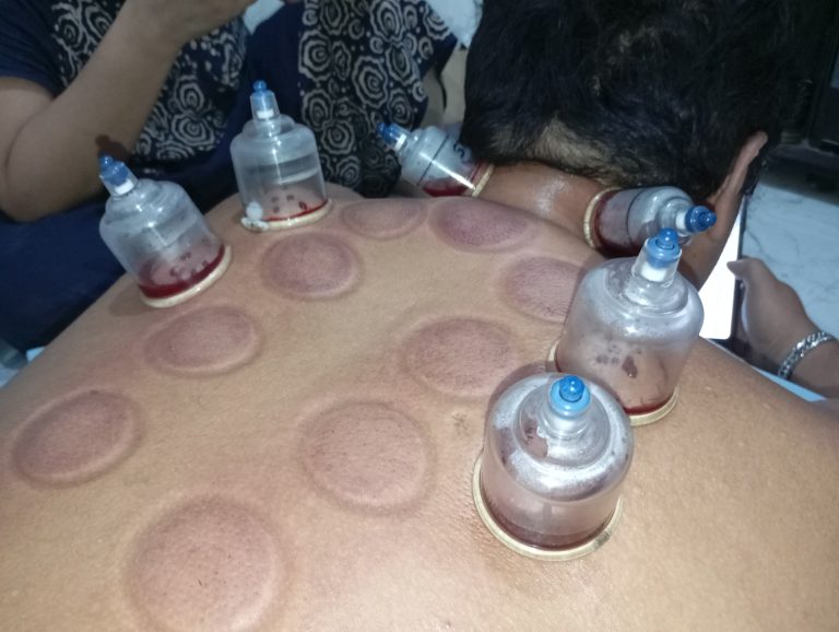 jasa bekam panggilan area bekasi